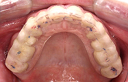bite-plate