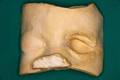 maxillo-facial-prosthesis