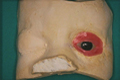 maxillo-facial-prosthesis